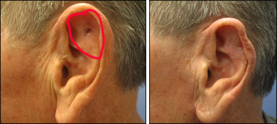 facelift